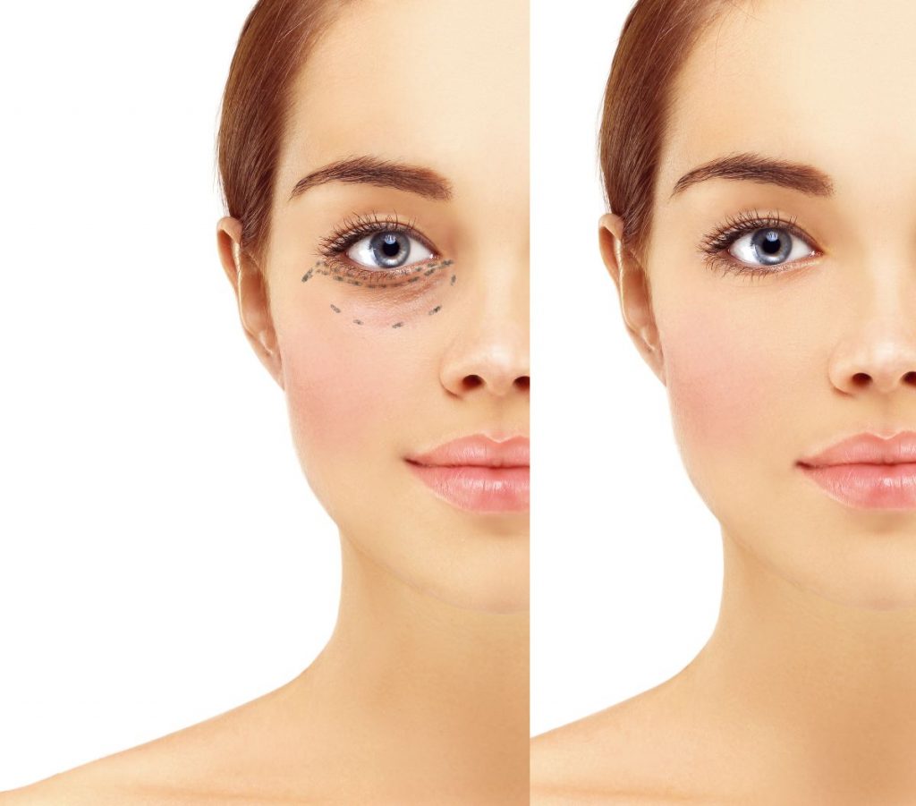 szemhejplasztika-mutet-elott-utan